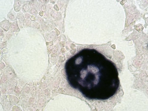 IHC of CD61 on an FFPE Bone Marrow Tissue